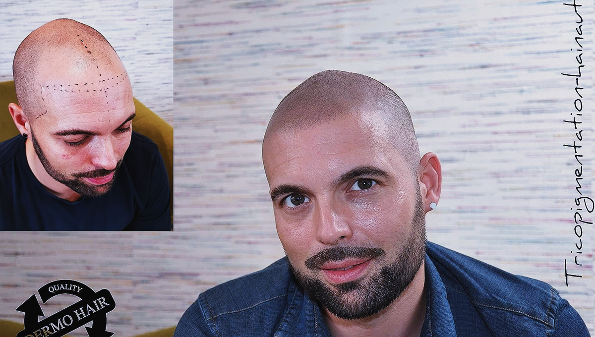 Avant / après d'un effet rasé homme réalisé au centre micropigmentation hainaut