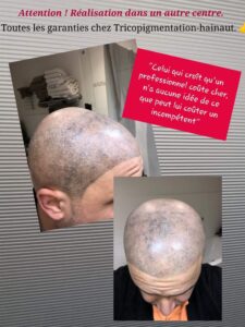 les dangers d'une mauvaise tricopigmentation